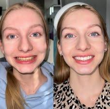 Instant purple tone-correcting strips that help improve the look of yellow tones in minutes — no peroxide, gentle formula